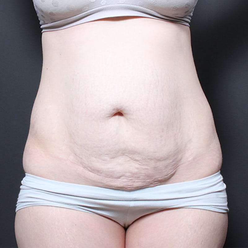 Tummy Tuck Before & After Gallery - Patient 764371 - Image 1