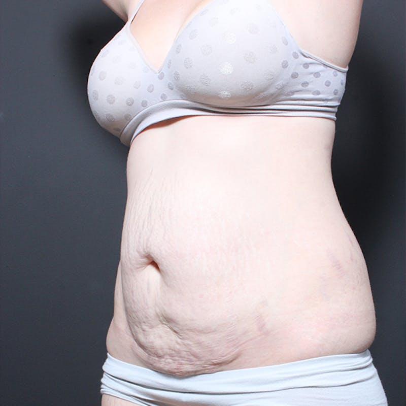 Tummy Tuck Before & After Gallery - Patient 764371 - Image 3