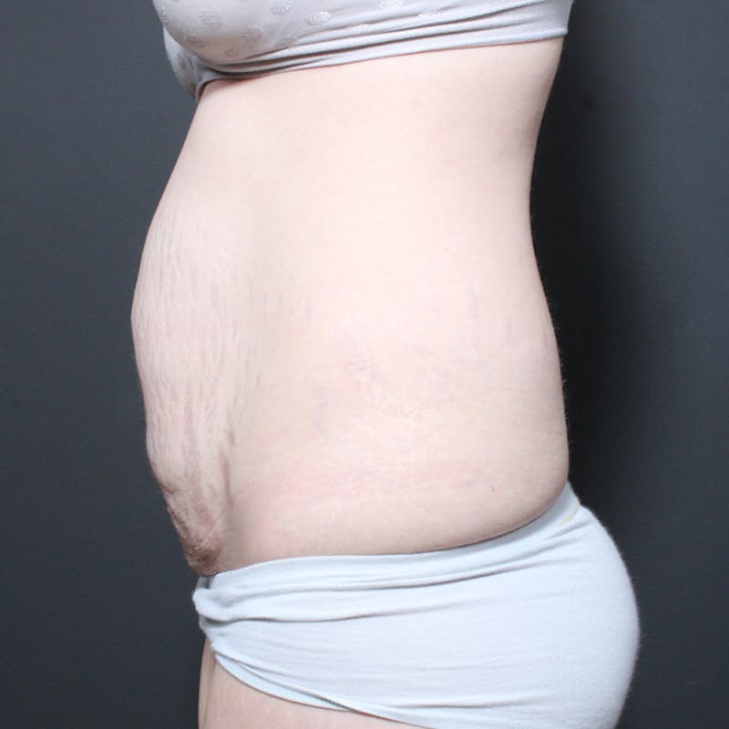 Tummy Tuck Before & After Gallery - Patient 764371 - Image 5