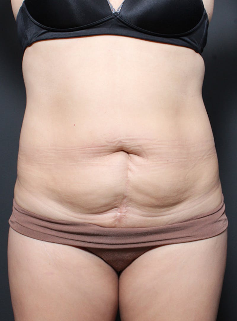 Tummy Tuck Before & After Gallery - Patient 322693 - Image 1