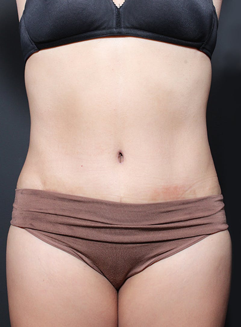 Tummy Tuck Before & After Gallery - Patient 322693 - Image 2