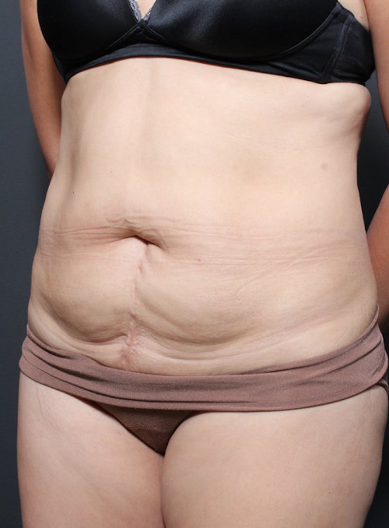 Tummy Tuck Before & After Gallery - Patient 322693 - Image 3
