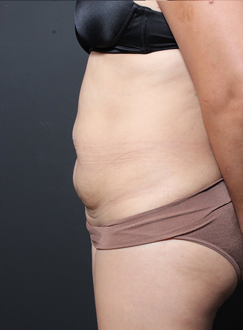 Tummy Tuck Before & After Gallery - Patient 322693 - Image 5