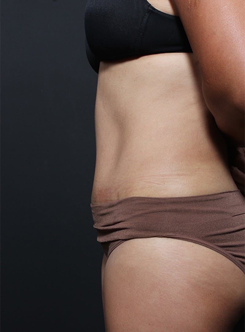 Tummy Tuck Before & After Gallery - Patient 322693 - Image 6