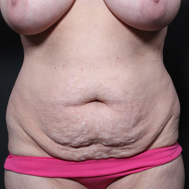 Tummy Tuck Before & After Gallery - Patient 425619 - Image 1