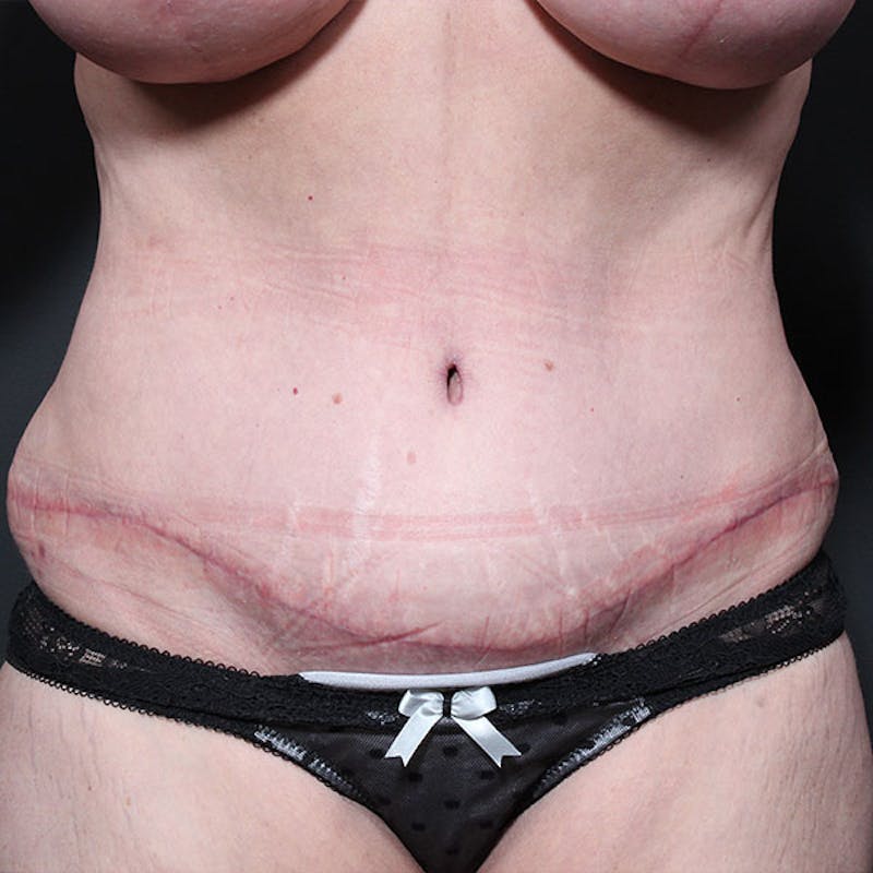 Tummy Tuck Before & After Gallery - Patient 425619 - Image 2