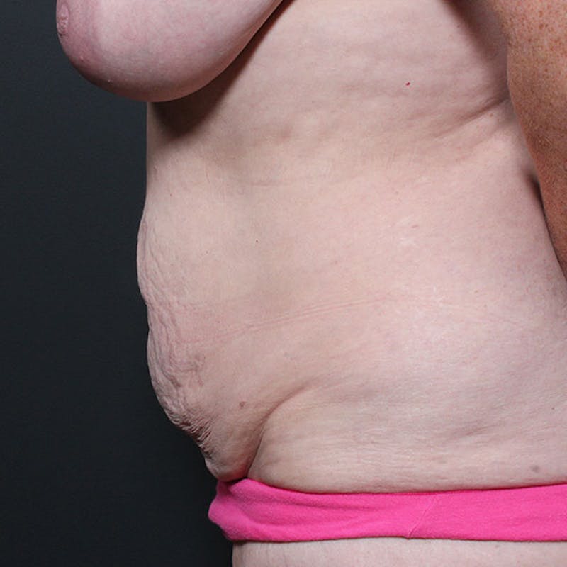 Tummy Tuck Before & After Gallery - Patient 425619 - Image 5