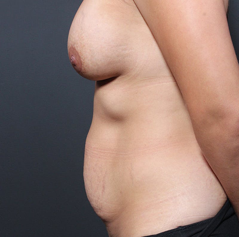Tummy Tuck Before & After Gallery - Patient 303593 - Image 5