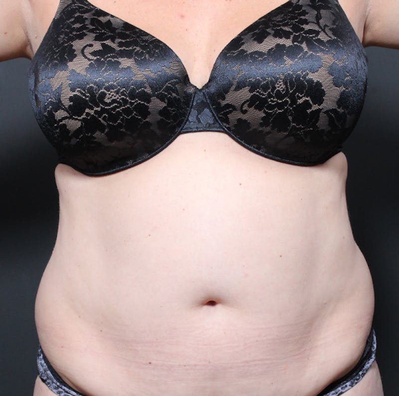 Tummy Tuck Before & After Gallery - Patient 524915 - Image 1