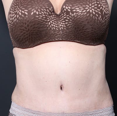 Tummy Tuck Before & After Gallery - Patient 524915 - Image 2