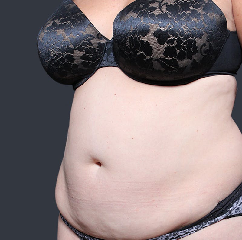 Tummy Tuck Before & After Gallery - Patient 524915 - Image 3