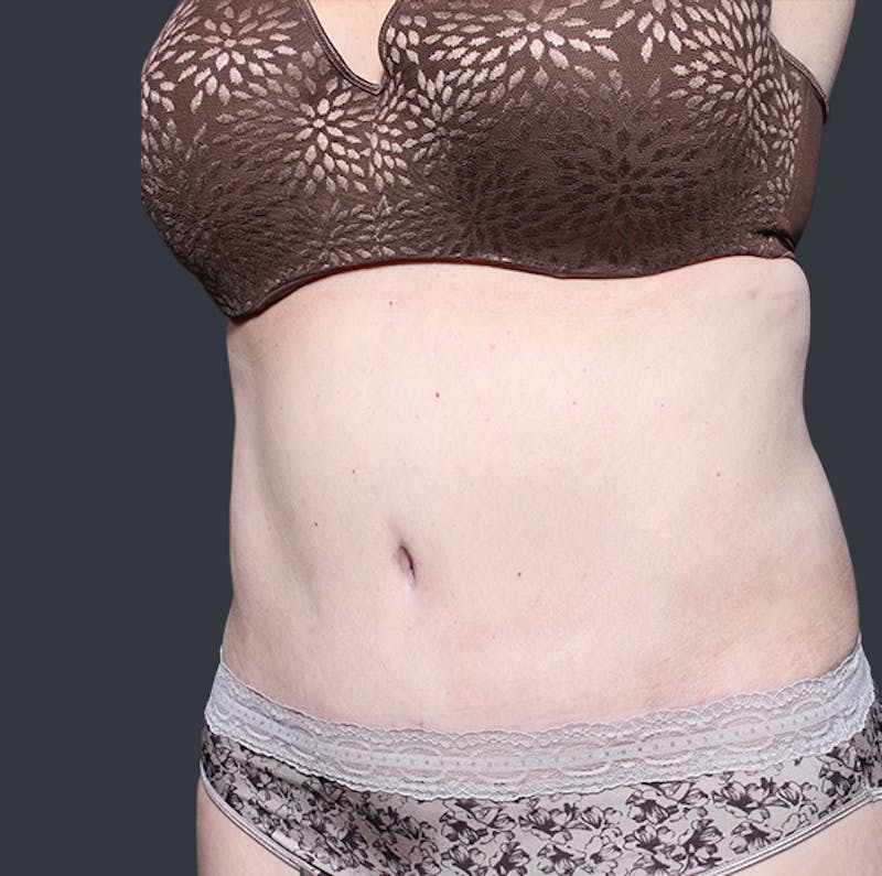 Tummy Tuck Before & After Gallery - Patient 524915 - Image 4