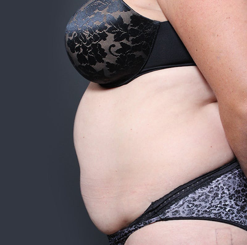 Tummy Tuck Before & After Gallery - Patient 524915 - Image 5