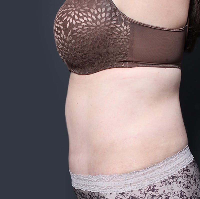 Tummy Tuck Before & After Gallery - Patient 524915 - Image 6