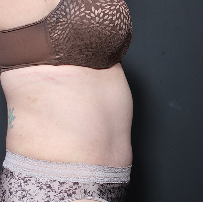 Tummy Tuck Before & After Gallery - Patient 524915 - Image 10