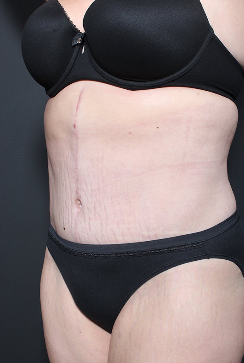 Tummy Tuck Before & After Gallery - Patient 968605 - Image 4