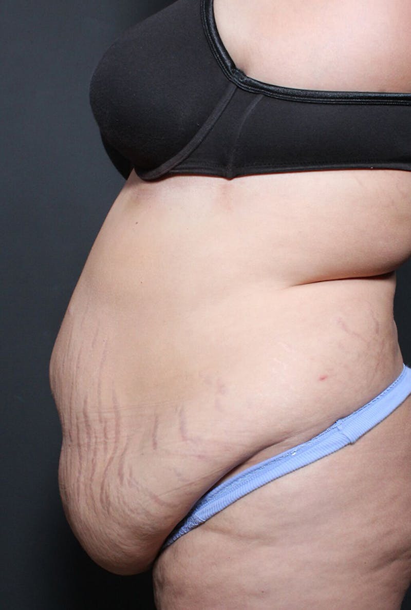 Tummy Tuck Before & After Gallery - Patient 247359 - Image 5