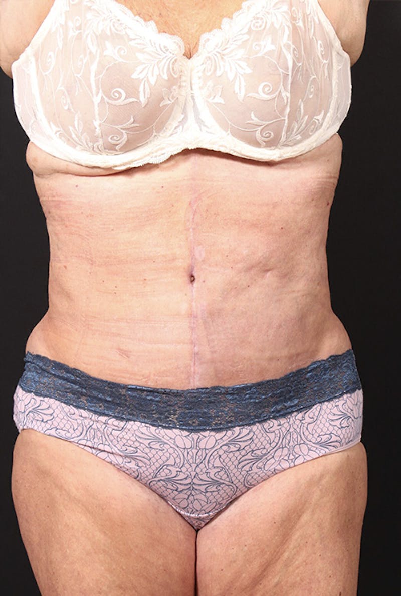 Tummy Tuck Before & After Gallery - Patient 761961 - Image 2