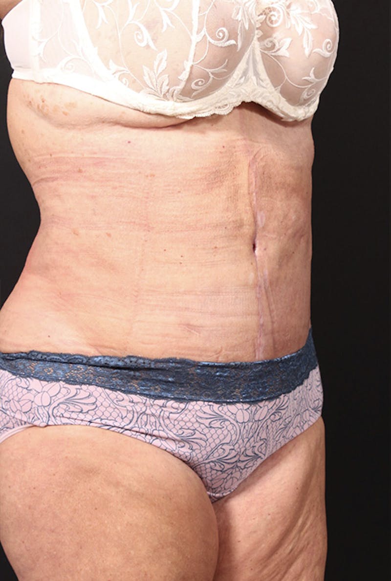 Tummy Tuck Before & After Gallery - Patient 761961 - Image 4
