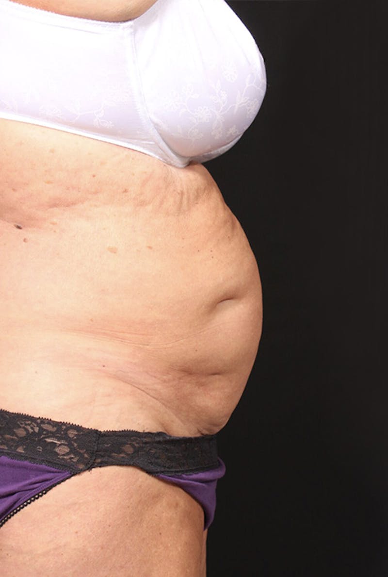 Tummy Tuck Before & After Gallery - Patient 761961 - Image 5
