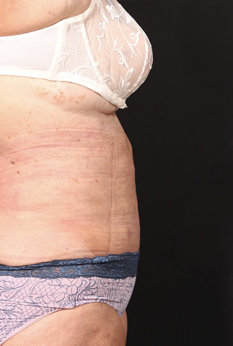 Tummy Tuck Before & After Gallery - Patient 761961 - Image 6