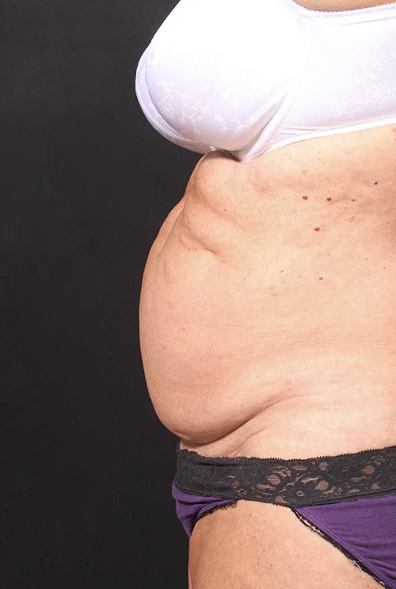 Tummy Tuck Before & After Gallery - Patient 761961 - Image 7