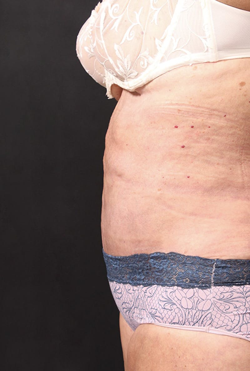 Tummy Tuck Before & After Gallery - Patient 761961 - Image 8