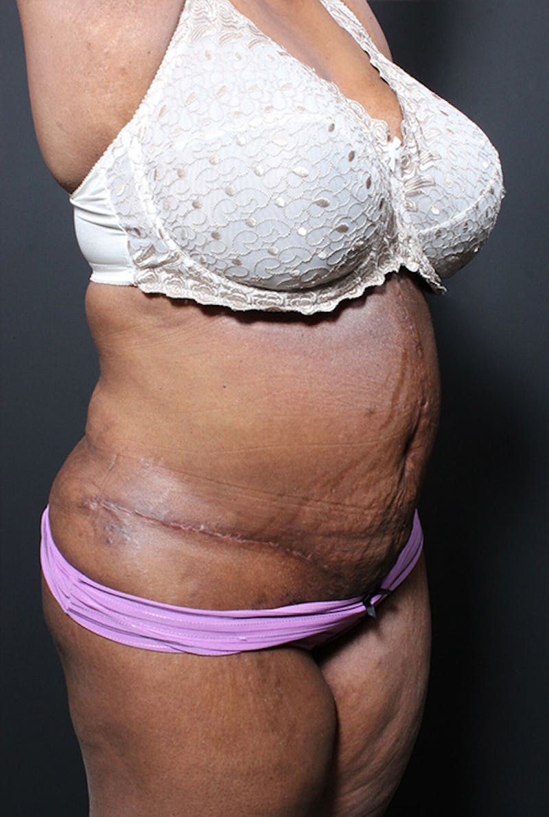 Tummy Tuck Before & After Gallery - Patient 764226 - Image 4