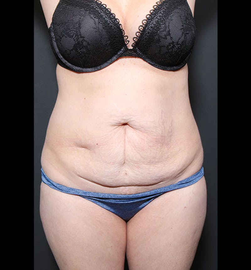 Tummy Tuck Before & After Gallery - Patient 352305 - Image 1