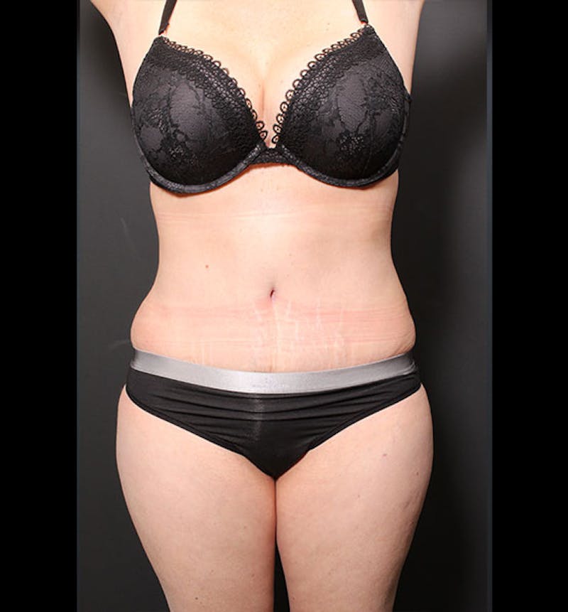 Tummy Tuck Before & After Gallery - Patient 352305 - Image 2