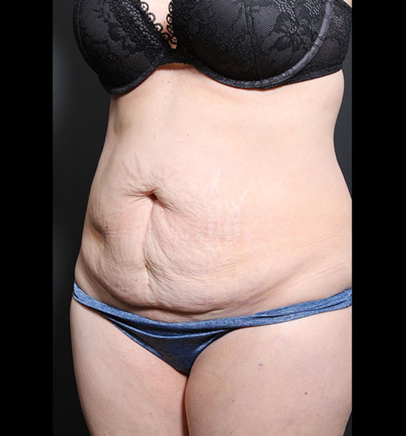 Tummy Tuck Before & After Gallery - Patient 352305 - Image 3