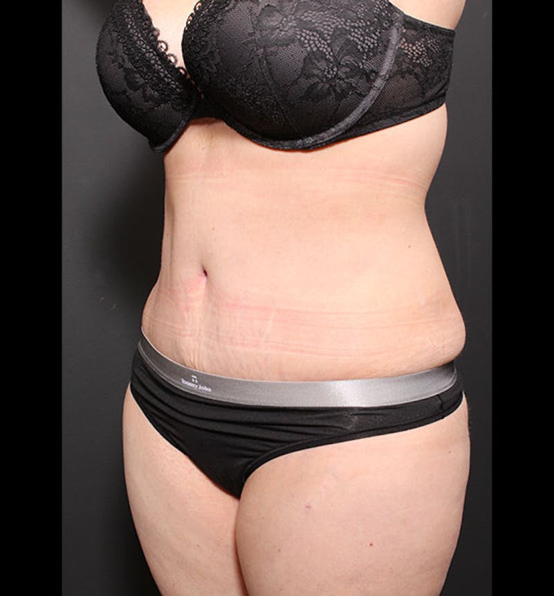 Tummy Tuck Before & After Gallery - Patient 352305 - Image 4