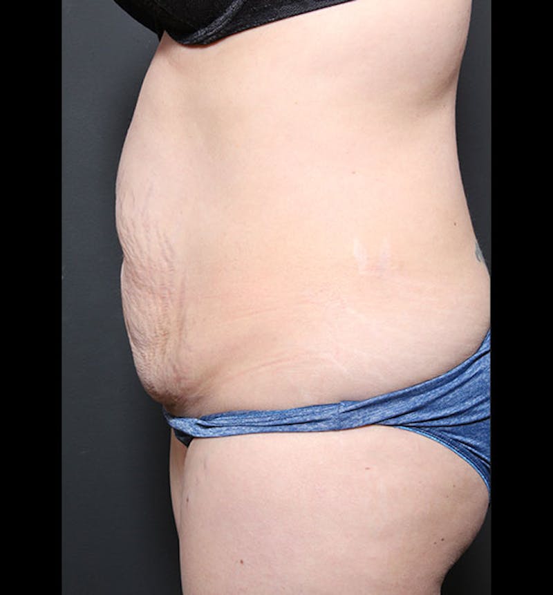Tummy Tuck Before & After Gallery - Patient 352305 - Image 5