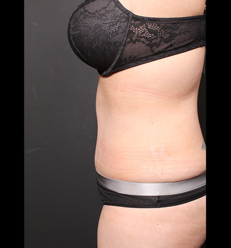 Tummy Tuck Before & After Gallery - Patient 352305 - Image 6