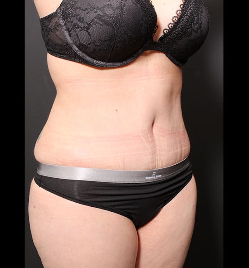 Tummy Tuck Before & After Gallery - Patient 352305 - Image 8