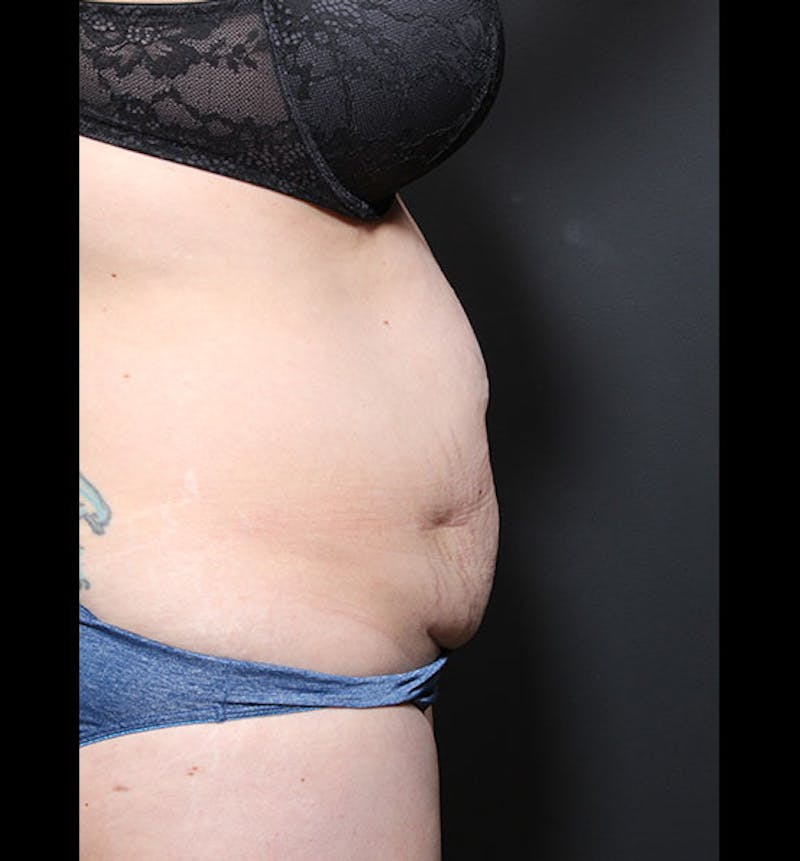 Tummy Tuck Before & After Gallery - Patient 352305 - Image 9