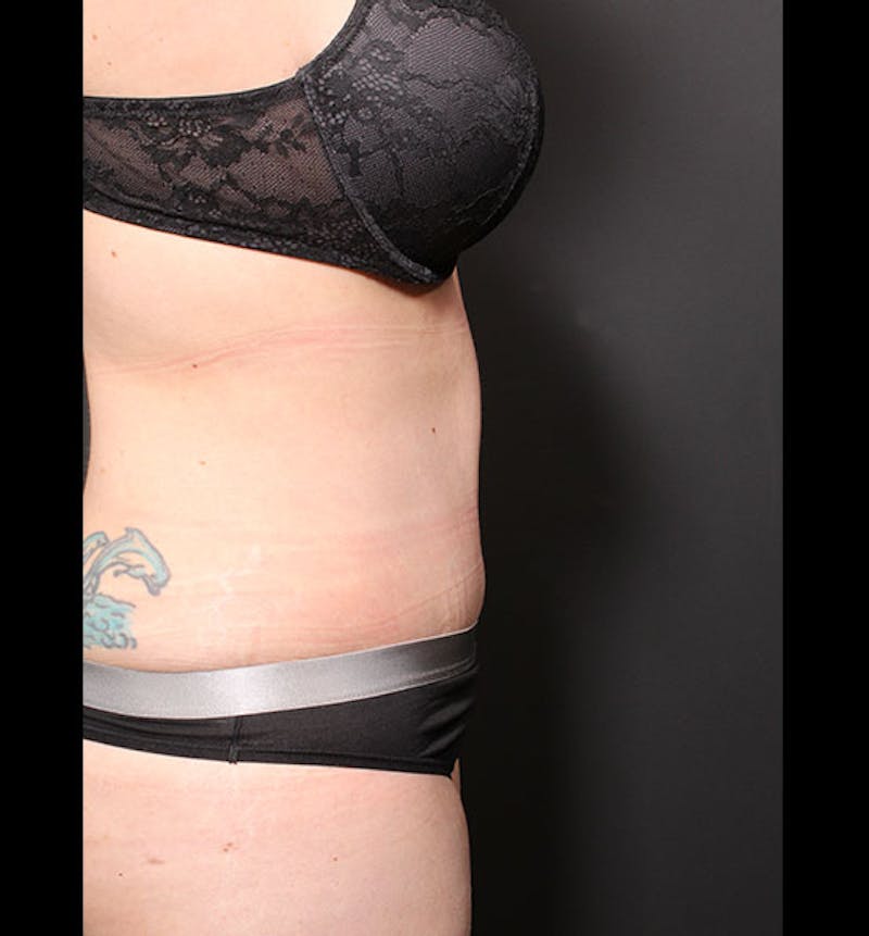 Tummy Tuck Before & After Gallery - Patient 352305 - Image 10
