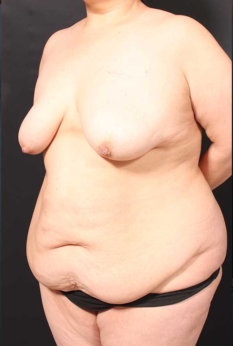Tummy Tuck Before & After Gallery - Patient 770091 - Image 3
