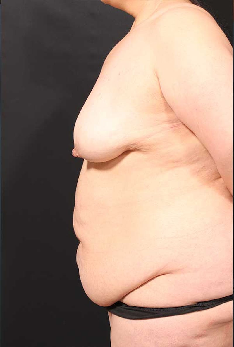 Tummy Tuck Before & After Gallery - Patient 770091 - Image 5