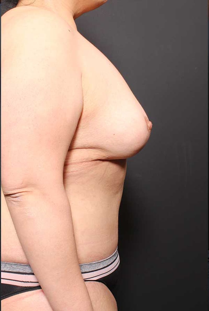 Tummy Tuck Before & After Gallery - Patient 770091 - Image 10