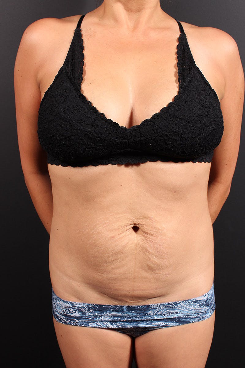Tummy Tuck Before & After Gallery - Patient 366273 - Image 1