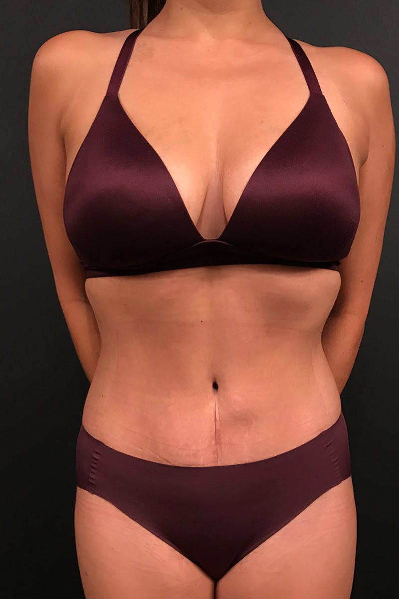 Tummy Tuck Before & After Gallery - Patient 366273 - Image 2
