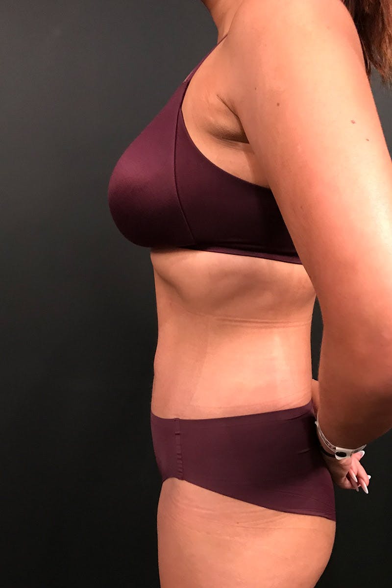 Tummy Tuck Before & After Gallery - Patient 366273 - Image 6