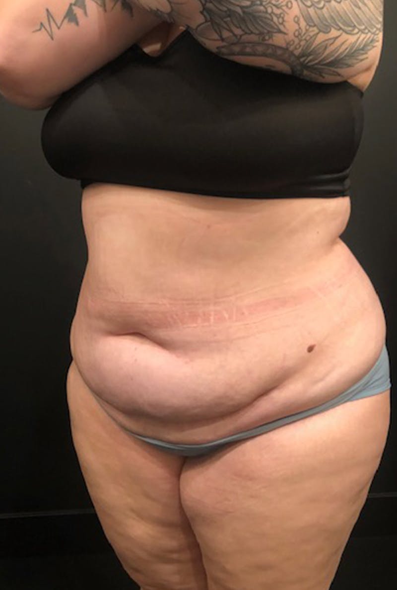 Tummy Tuck Before & After Gallery - Patient 168833 - Image 1