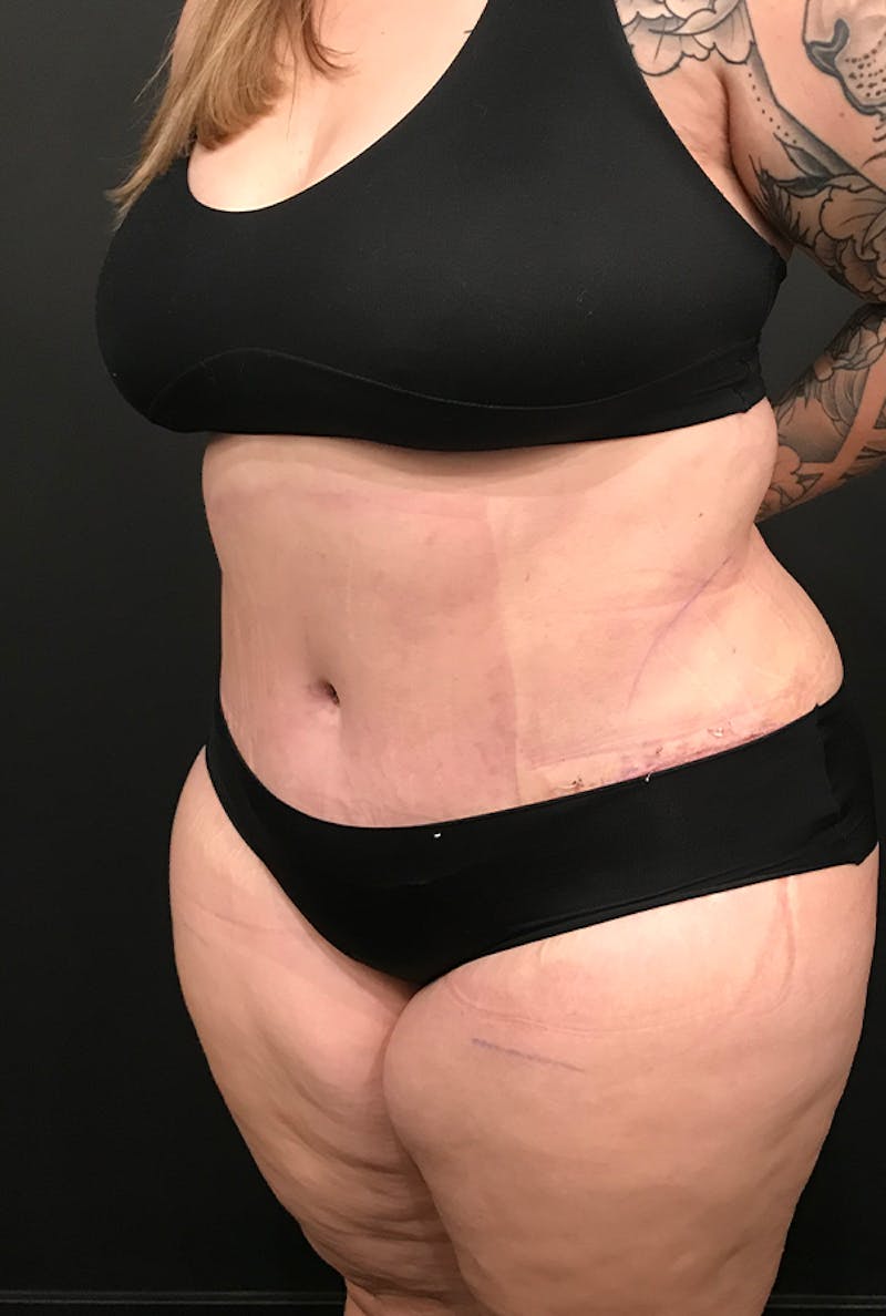 Tummy Tuck Before & After Gallery - Patient 168833 - Image 2