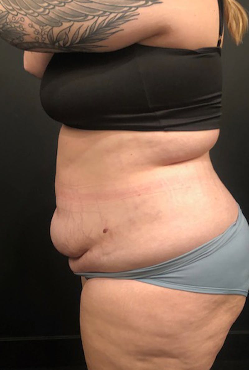 Tummy Tuck Before & After Gallery - Patient 168833 - Image 3