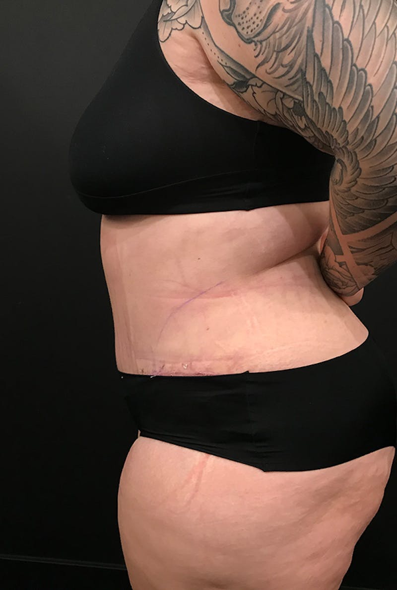 Tummy Tuck Before & After Gallery - Patient 168833 - Image 4