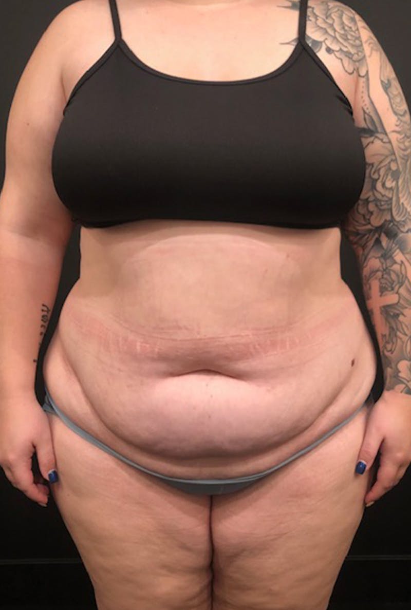 Tummy Tuck Before & After Gallery - Patient 168833 - Image 5