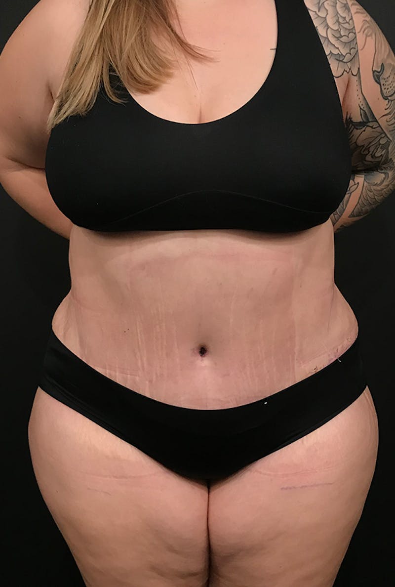 Tummy Tuck Before & After Gallery - Patient 168833 - Image 6