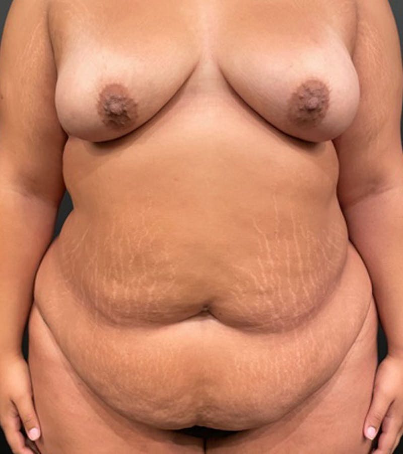 Tummy Tuck Before & After Gallery - Patient 252222 - Image 1